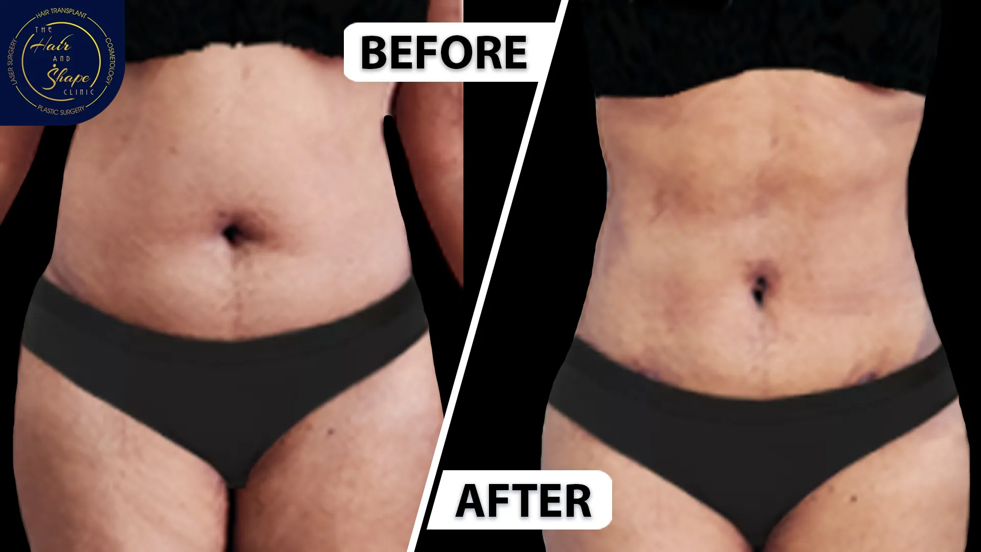 Liposuction result3